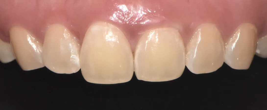 Before: yellowed front teeth