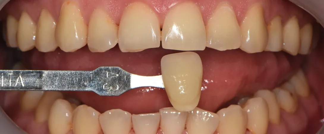 Before: teeth matched to VITA shade A3